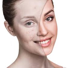 Acne Treatment-1